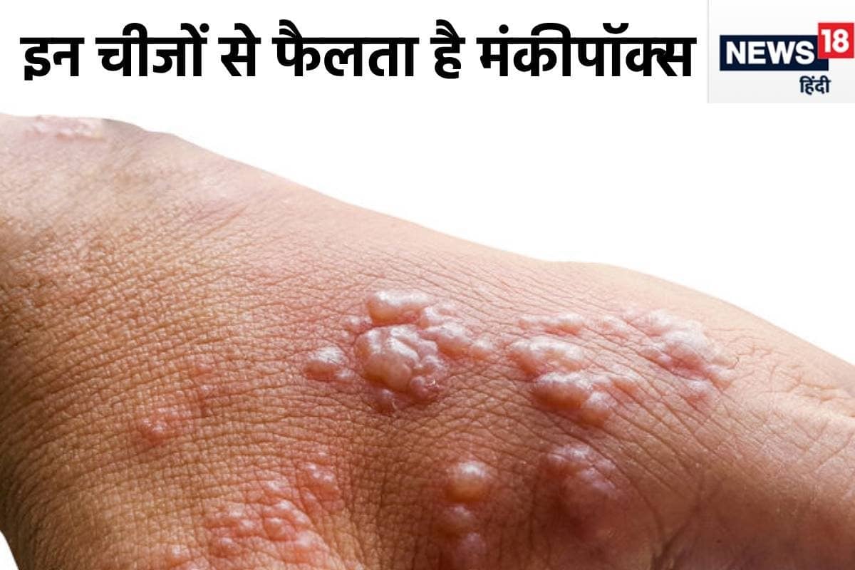 monkeypox mpox kaise failta hai 2024 08 d66ac681f3e83ca8384e2254af776d3d 3x2 qo6cLf